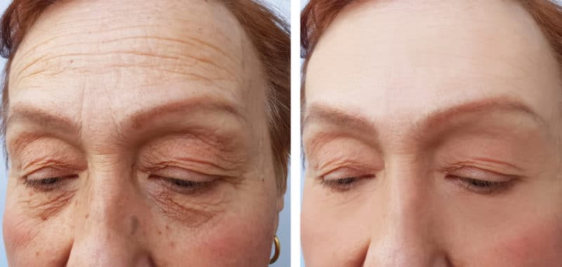 Botox Injections in Scottsdale, AZ - Botox Treatment