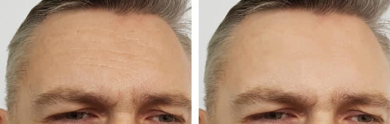 Botox for Men in Scottsdale, AZ - Mens Botox Treatments - Wrinkle Repair for Men