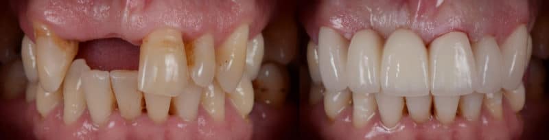 Dental Bridge in Scottsdale, AZ - Bridge Dentist - Ceramic Zirconia Dental Bridge