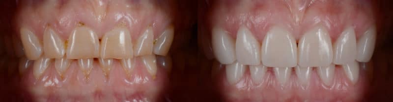 Dental Veneers in Scottsdale, AZ - Affordable Dental Veneers Near Me - Veneers Before & After