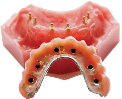 Dentures-in-Scottsdale,-AZ---Implant-Supported-Dentures