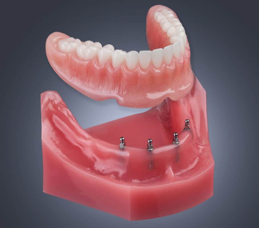 Implant Retained Dentures for Missing Teeth or Secure Dentures