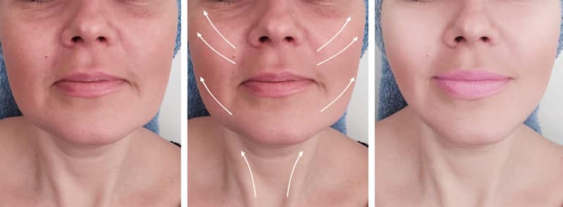 Juvéderm Voluma XC - Cheek Correction & Dermal Fillers in Scottsdale, AZ