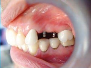 Mini Dental Implant Placed - Dr. Todd Shatkin
