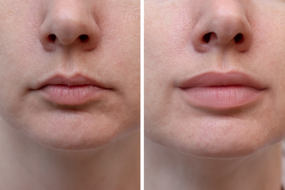 Restylane Dermal Fillers in Scottsdale, AZ Lyft, Silk, Refyne Near Me