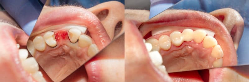 Tooth Extraction Dentist in Scottsdale, AZ - Pulled Tooth - Tooth Removal