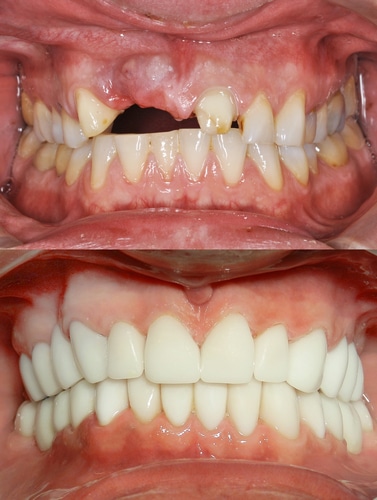 Full Mouth Restoration Vacation - Scottsdale Dental & Facial Aesthetics - Before & After Dental Reconstruction