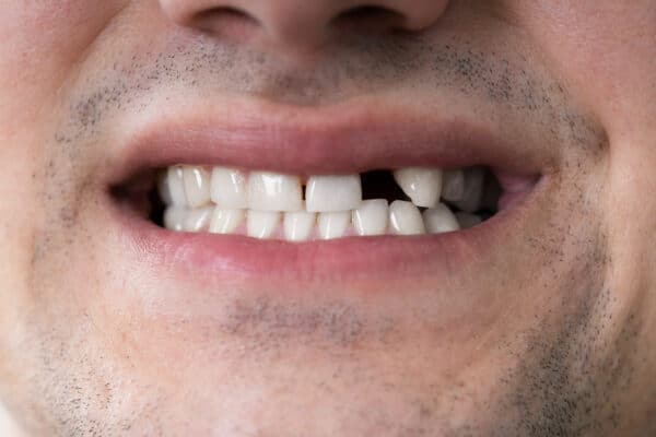 Broken Teeth Fix Your Smile