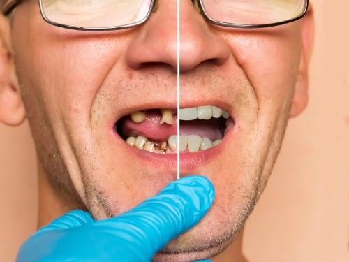 Causes of Tooth Loss & Solutions We Offer Scottsdale Implant Dentist