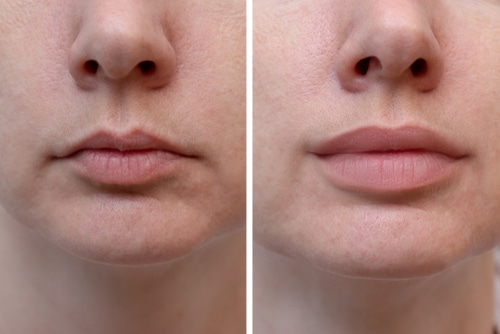 Lip Flip Cosmetic Treatment for Fuller Lips Free Consultation Scottsdale
