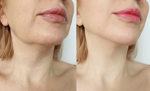 Double Chin Treatment Kybella Injections Free Kybella Consultations