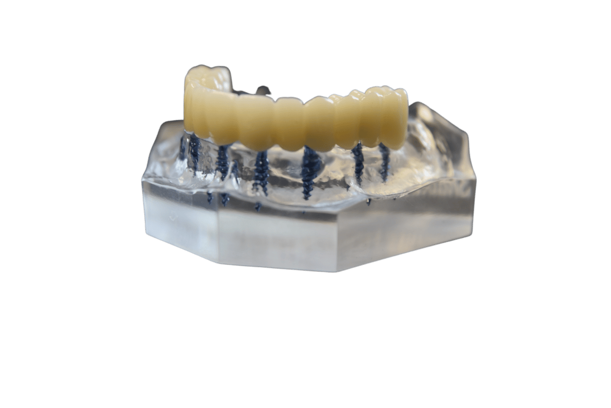 Permanent Dentures in Scottsdale, AZ Implant Retained Dentures