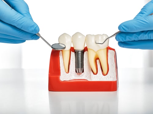 Affordable Dental Implants Scottsdale Dental & Facial Aesthetics