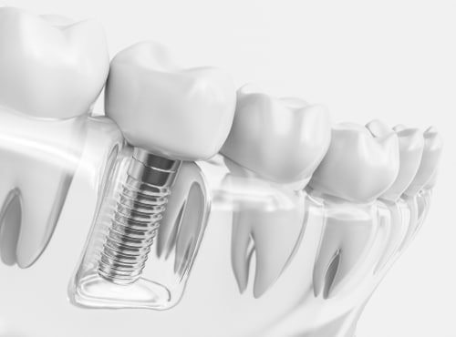 Dental Implants in Scottsdale Cosmetic Dentist Dr. Todd Shatkin