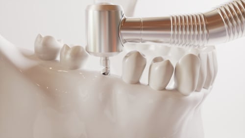Mini Dental Implants in Scottsdale AZ Learn More Today