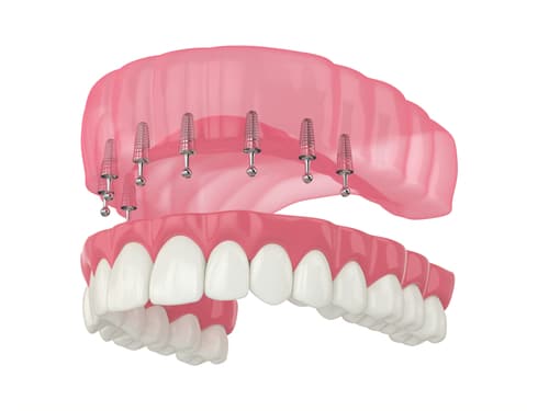 Mini Implant Denture Cost Scottsdale Dental & Facial Aesthetics