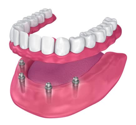 Snap on Dentures in Scottsdale Arizona Learn More Today