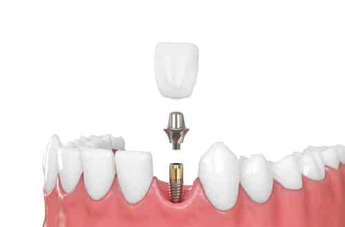Tooth Implant Options at Scottsdale Dental and Facial Aesthetics