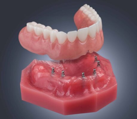 Denture Replacement in Scottsdale, AZ | Mini Implants | Dr. Mann
