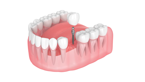 Implant Dentist in Scottsdale, AZ | Mini Implants | Dr. Todd Shatkin